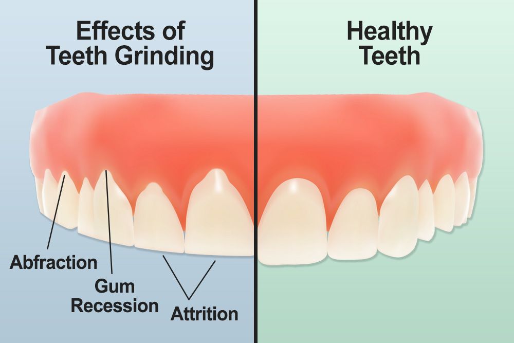 Teeth grinding versus healthy teeth