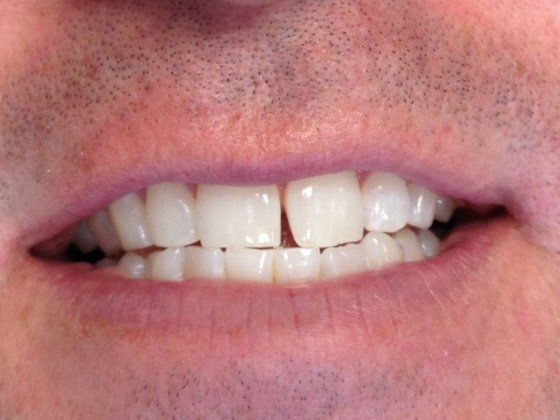 Before: patient's smile with a gap between the front teeth.
