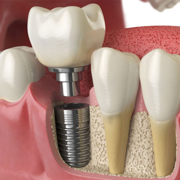 dental implant