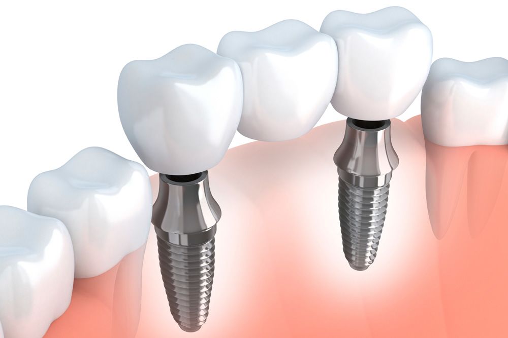 Illustration of an implant-supported bridge