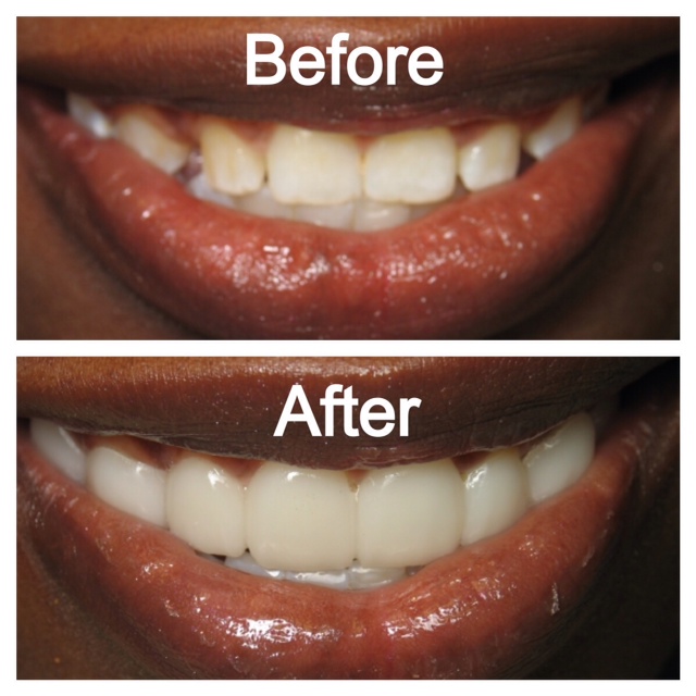 Snap_On_Smile_Kansas_City.jpg Snap-On Smile® before and after photos.