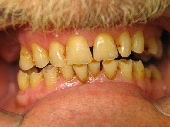 Before full mouth reconstruction