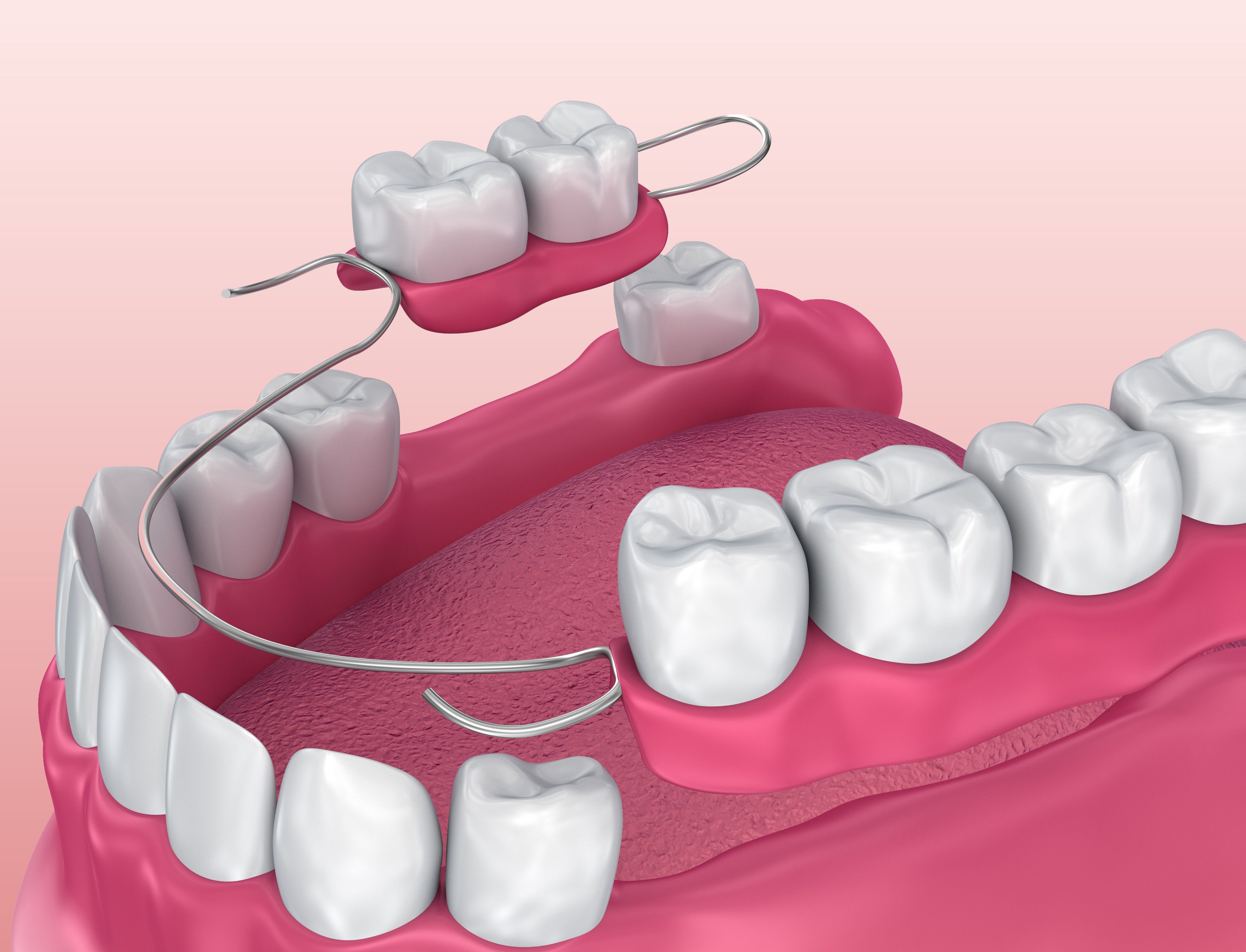 partial denture